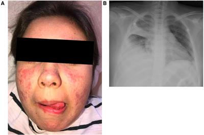 Case Report: p40phox deficiency underlying pediatric-onset systemic lupus erythematosus